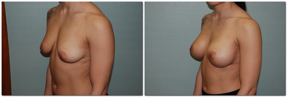 before and after Breast Augmentation diagonal angle view Case 962