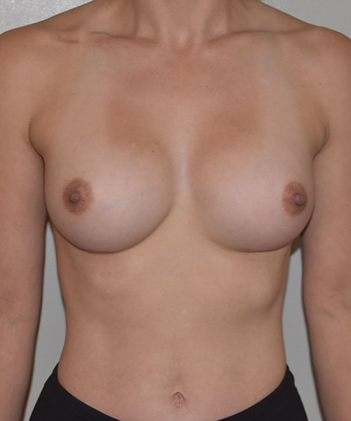 after breast augmentation front view case 2803