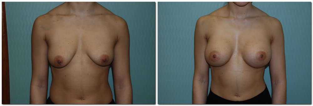 before and after Breast Augmentation front angle view Case 962