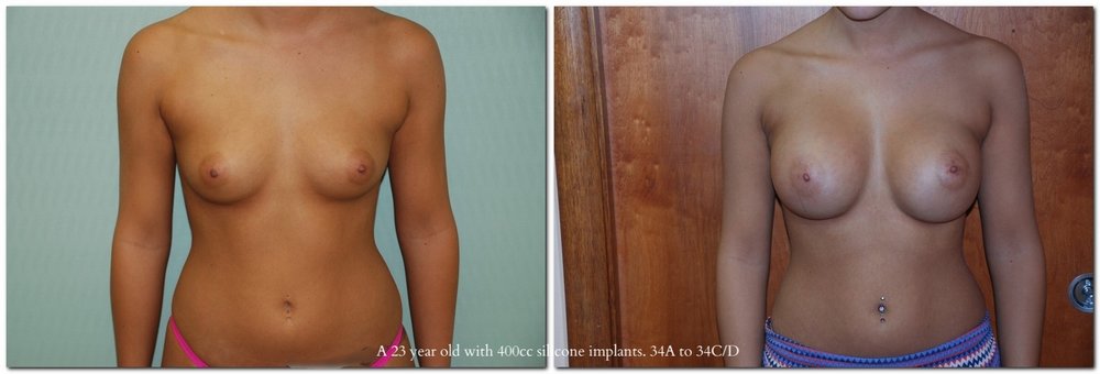 before and after Breast Augmentation front angle view Case 966