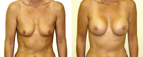 Before and After Breast Augmentation Female Patient Front Angle View Case 997