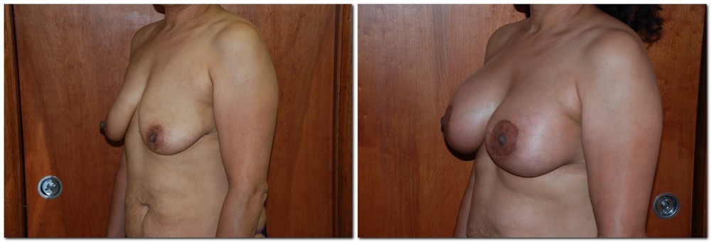before and after Breast Lift diagonal angle view Case 927