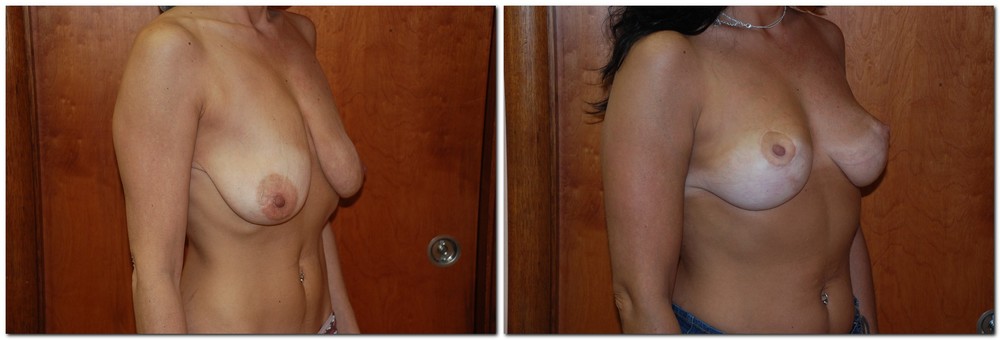 before and after Breast Lift diagonal angle view Case 923
