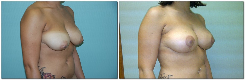 before and after Breast Lift female patient diagonal angle view Case 915