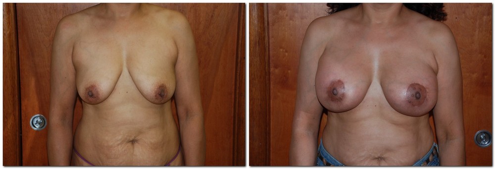 before and after Breast Lift front angle view Case 927