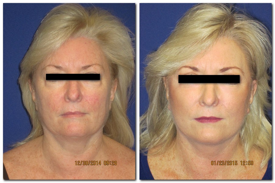 before and after Facelift / Neck Lift female patient front angle view Case 2430