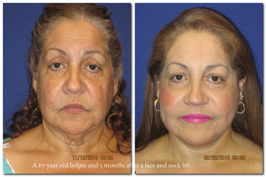 before and after Facelift / Neck Lift female patient front angle view Case 2434