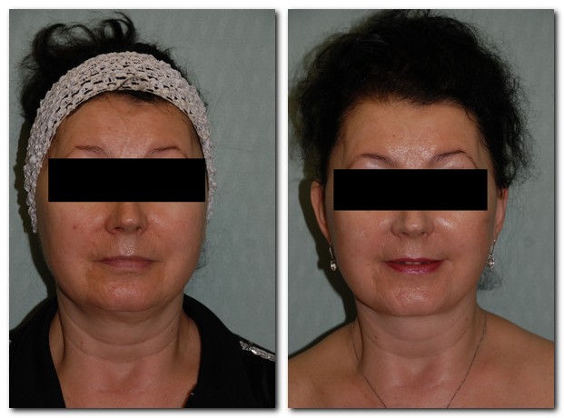 before and after Facelift / Neck Lift female patient front angle view Case 2438