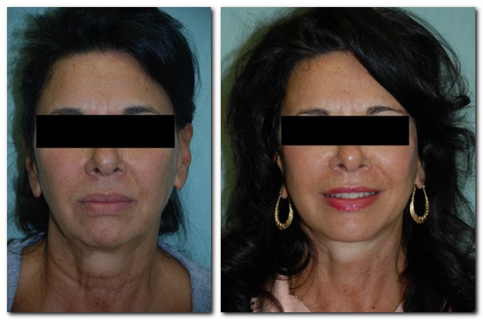 before and after Facelift / Neck Lift female patient front angle view Case 2442