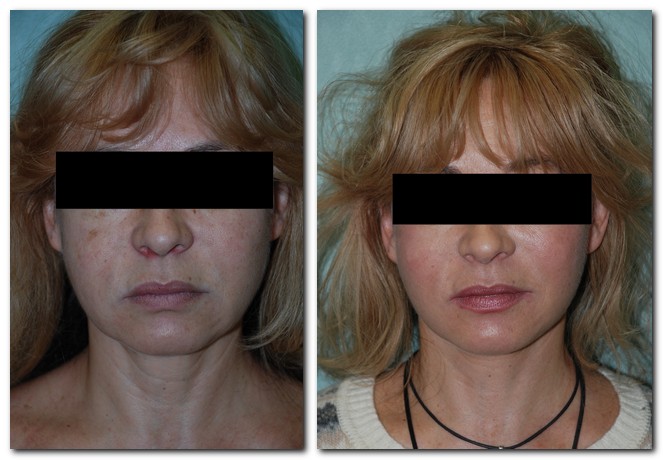 before after Facelift / Neck Lift front angle view Case 2446