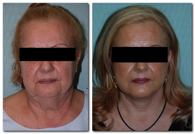 before and after Facelift / Neck Lift front angle view Case 2448