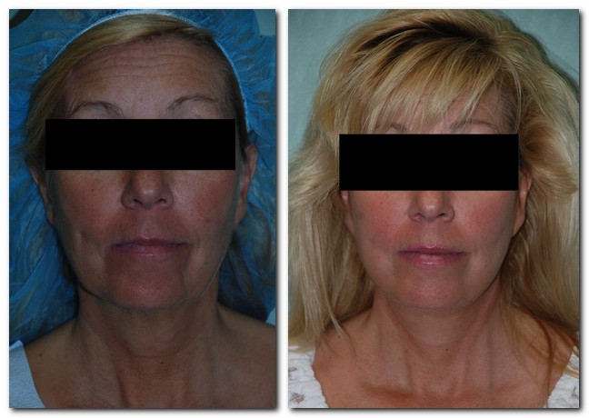 before and after Facelift / Neck Lift front angle view Case 2455