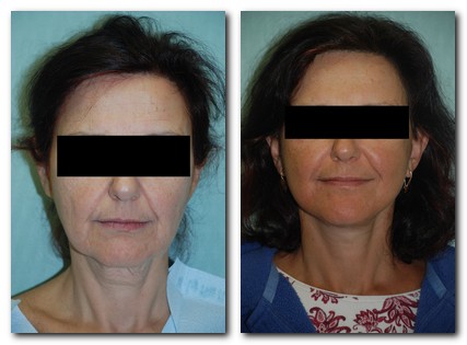 before and after Facelift / Neck Lift front angle view Case 2463