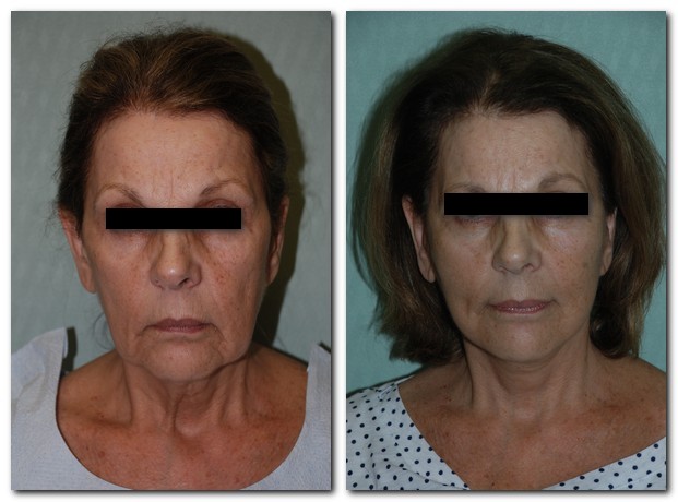before and after Facelift / Neck Lift front angle view Case 2468