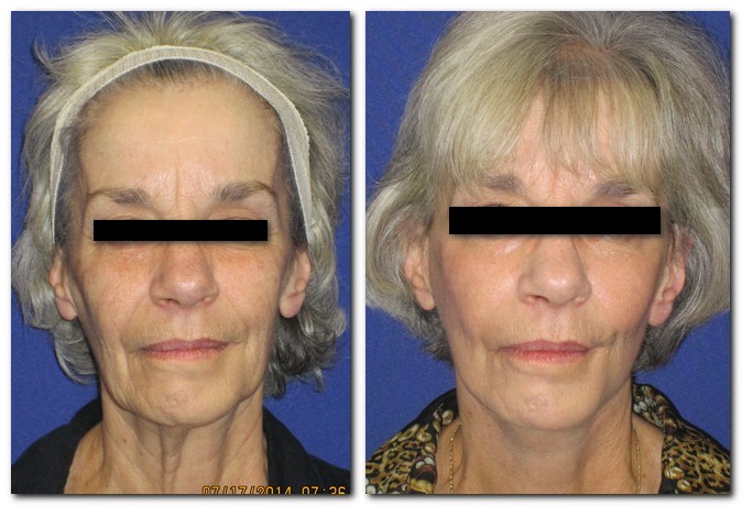 before and after Facelift / Neck Lift female patient front angle view Case 2474