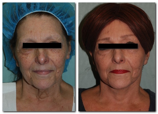 before and after Facelift / Neck Lift front angle view Case 2476