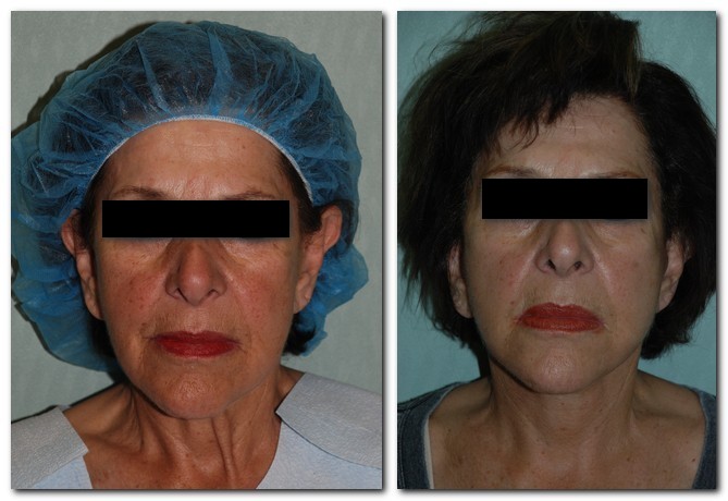 before and after Facelift / Neck Lift female patient front angle view Case 2483
