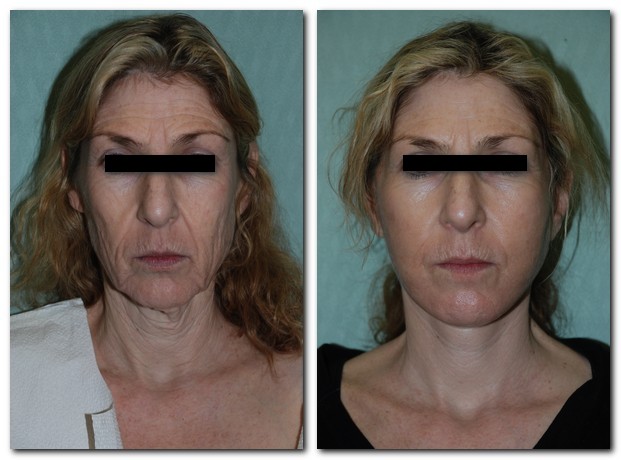 before and after Facelift / Neck Lift female patient front angle view Case 2488