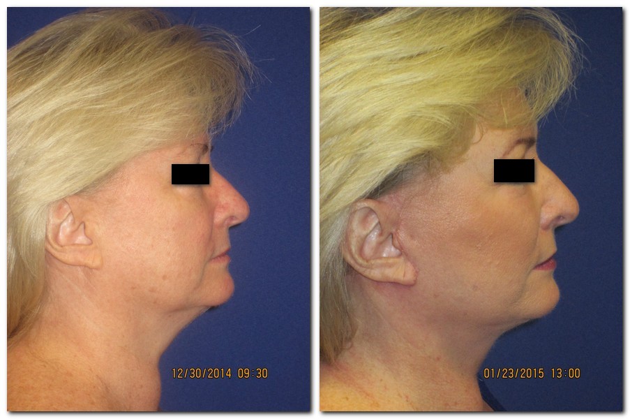 before and after Facelift / Neck Lift female patient side angle view Case 2430