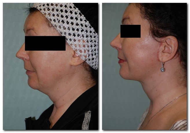 before and after Facelift / Neck Lift female patient side angle view Case 2438