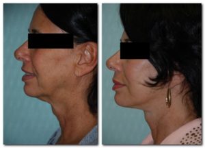 before and after Facelift / Neck Lift female patient side angle view Case 2442