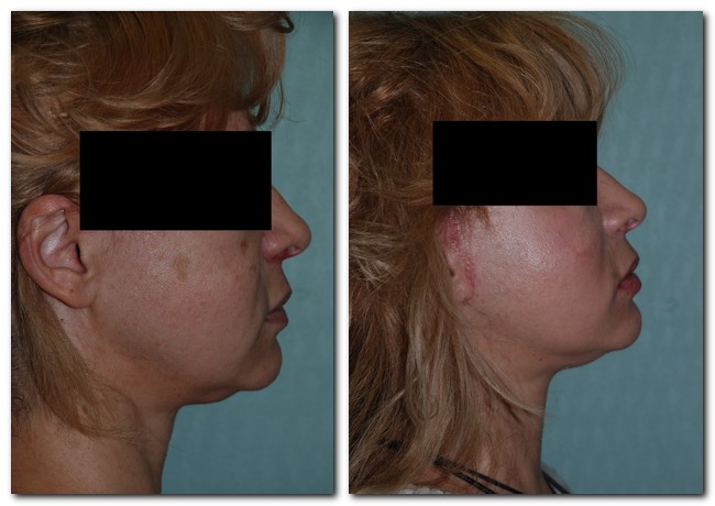 before after Facelift / Neck Lift side angle view Case 2446