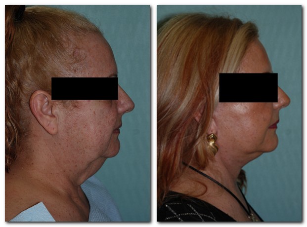 before and after Facelift / Neck Lift side angle view Case 2448