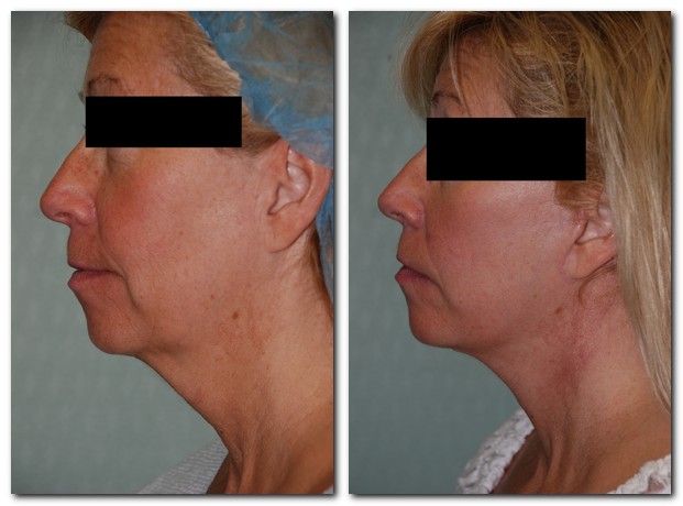 before and after Facelift / Neck Lift side angle view Case 2455