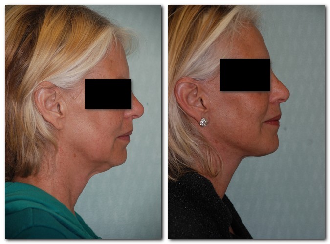 before and after Facelift / Neck Lift side angle view Case 2459