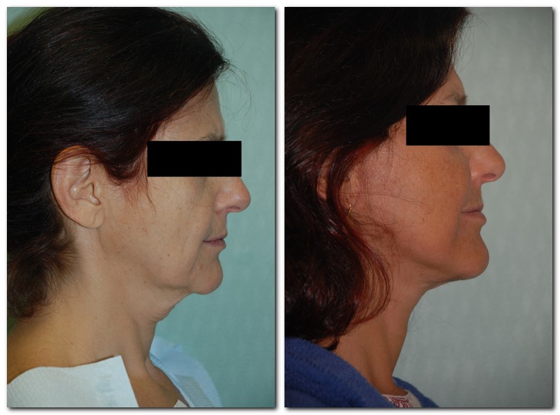 before and after Facelift / Neck Lift side angle view Case 2463