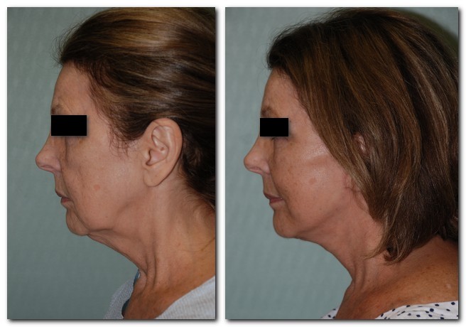 before and after Facelift / Neck Lift side angle view Case 2468