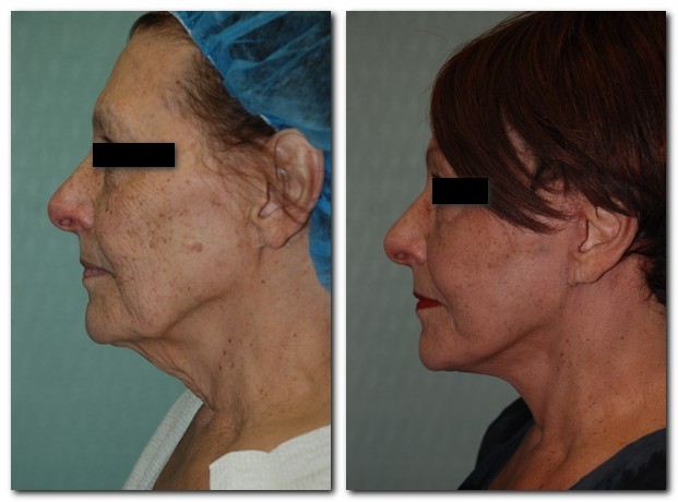 before and after Facelift / Neck Lift side angle view Case 2476