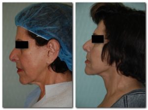 before and after Facelift / Neck Lift female patient side angle view Case 2483