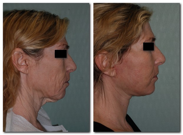 before and after Facelift / Neck Lift female patient side angle view Case 2488