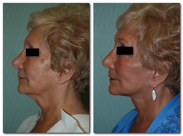 before and after Facelift / Neck Lift female patient side angle view Case 2492