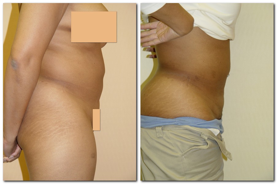 Before and After Liposuction Female Patient Side Angle View Case 2342