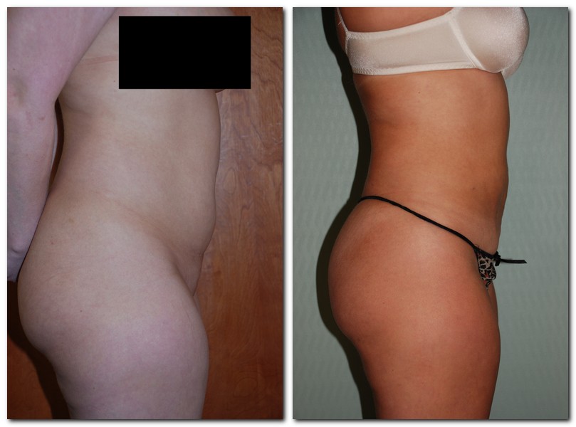 Before and After Liposuction Female Patient Side Angle View Case 2350