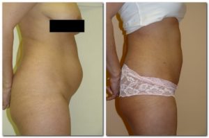 Before and After Liposuction Female Patient Side Angle View Case 2354