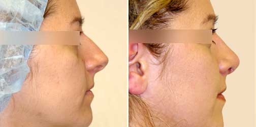 before and after Rhinoplasty female patient side angle view Case 949