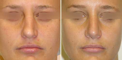 before and after Rhinoplasty female patient front angle view Case 941