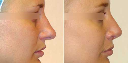 before and after Rhinoplasty female patient side angle view Case 941