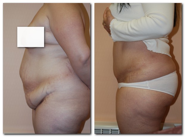 before and after Tummy Tuck female patient left side angle view Case 2374
