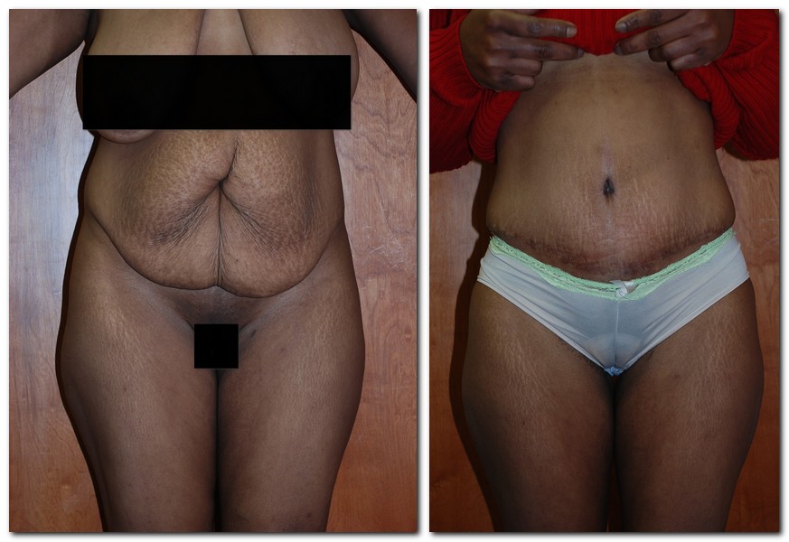 before and after Tummy Tuck female patient front angle view Case 2399