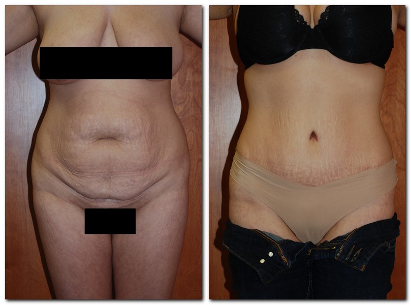 before and after Tummy Tuck front angle view Case 2418