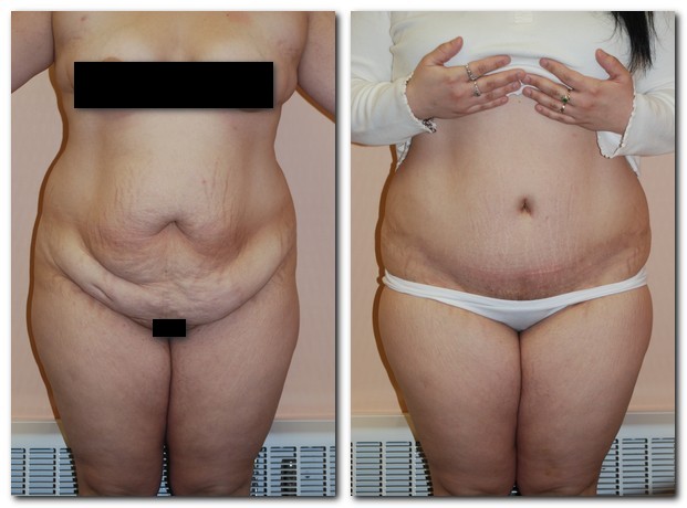 before and after Tummy Tuck female patient front angle view Case 2374