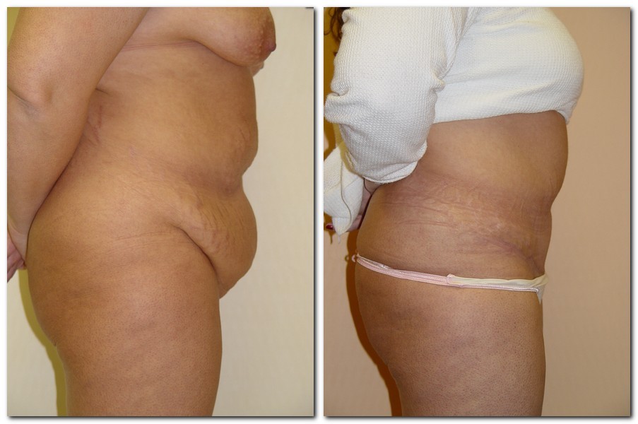 before and after Tummy Tuck female patient right side angle view Case 2374