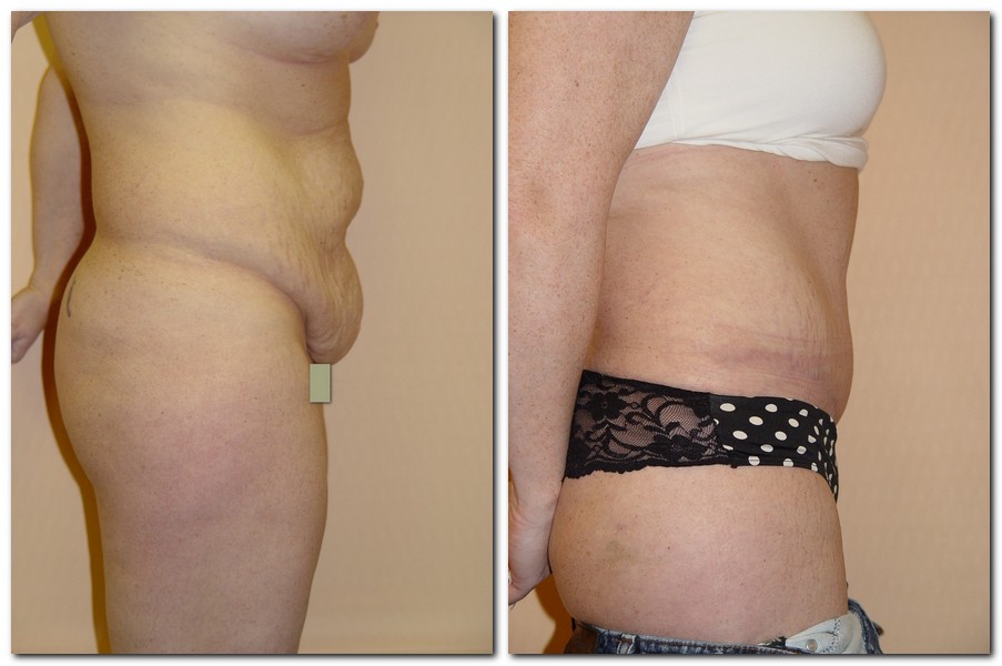 before and after Tummy Tuck female patient side angle view Case 2393