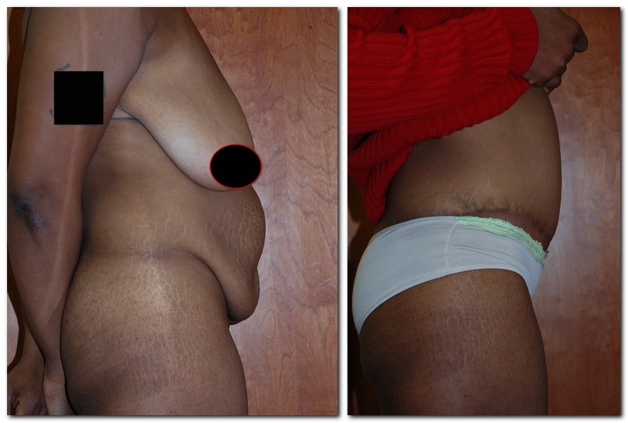 before and after Tummy Tuck female patient side angle view Case 2399