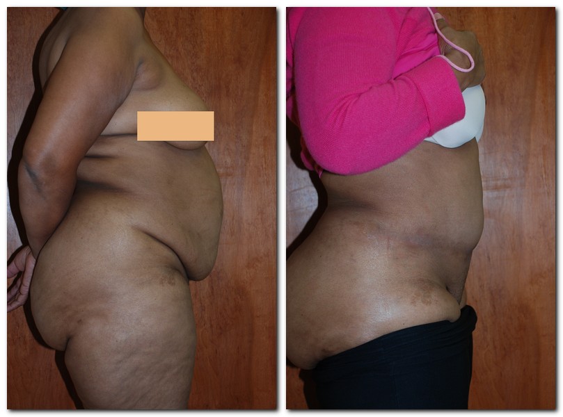 before and after Tummy Tuck side angle view Case 2403