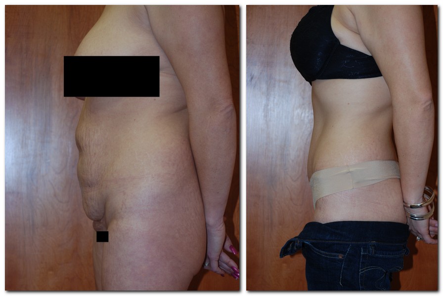 before and after Tummy Tuck side angle view Case 2418